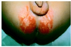 Baby with severe diaper rash. ( Custom Medical Stock Photo, Inc.)