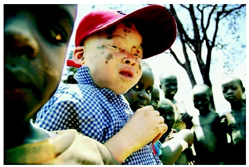 African child with albinism surrounded by normally pigmented friends. ( Silvia Morara/Corbis.)