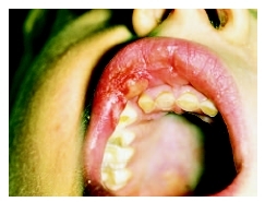 Close-up view of a boy with an allergic reaction on his lip as a result of contact with a latex glove. ( Dr. P. Marazzi/Photo Researchers, Inc.)