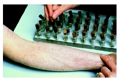 A scratch test is used to identify reactions to allergens. (Custom Medical Stock Photo Inc.)