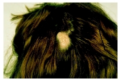 Bald spot on the scalp from the effects of alopecia. ( Mediscan/Visuals Unlimited.)