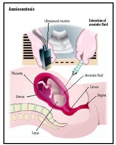 To perform amniocentesis, a physician uses an ultrasound monitor to visualize the fetus while inserting a syring to extract amnniotic fluid for analysis. (Illustration by GGS Information Services.)