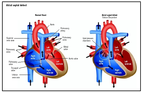 A normal heart (left) and one affected by atrial septal defect. The defect is a hole in the wall that separates the chambers of the heart, resulting in the mixing of oxygenated and unoxygenated blood. (Illustration by GGS Information Services.)