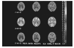 Bipolar disorder shown in a series of positron emission tomography (PET) scans. (Dr. Michael E. Phelps.)