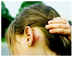 Mosquito bite behind the ear of a girl. ( Deb Yeske/Visuals Unlimited.)