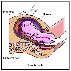 Approximately 34% of babies will start labor in the breech (buttocks first) position. While this is a potentially dangerous situation, many full-term babies can be safely delivered from the breech position. (Illustration by Electronic Illustrat