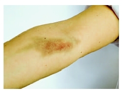 Bruised arm of a child. ( Garo/Photo Researchers, Inc.)