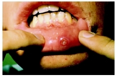 Apthous ulcer, or canker sore, on the inside of a patients bottom lip. ( Lester V. Bergman/Corbis.)