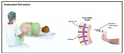 For cerebrospinal fluid collection, the health-care provider puts a syringe between the patients vertebrae and pulls out a sample of the fluid surrounding the spinal cord. (Illustration by GGS Information Services.)