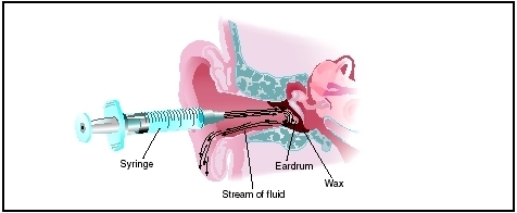 Ear wax is removed by flushing the ear canal with warm fluid. (Illustration by Argosy, Inc.)