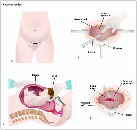 To remove a baby by cesarean section, an incision is made into the abdomen, usually just above the pubic hairline (A). The uterus is located and divided (B), allowing for delivery of the baby (C). After all the contents of the uterus are remove
