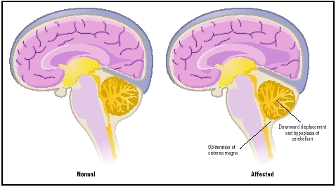 Comparison of normal brain (left) with brain affected by Arnold-Chiari malformation. (Illustration by Argosy. Inc.)