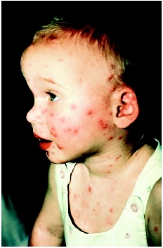 Child with chickenpox on the face and chest. (Photograph by John D. Cunningham. Visuals Unlimited.)