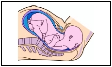 Childbirth in stage 2. The babys head is crowning and about to emerge from the vagina. (Illustration by Hans  Cassidy.)
