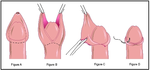 A typical circumcision procedure involves the following steps: Figure A: The surgeon makes an incision around the foreskin. Figure B: The foreskin is then freed from the skin covering the penile shaft. Figure C: The surgeon cuts the foreskin to