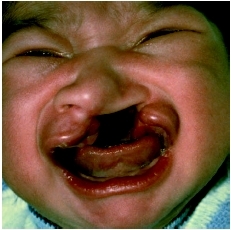 Infant with a unilateral cleft lip and palate. (Custom Medical Stock Photo Inc.)
