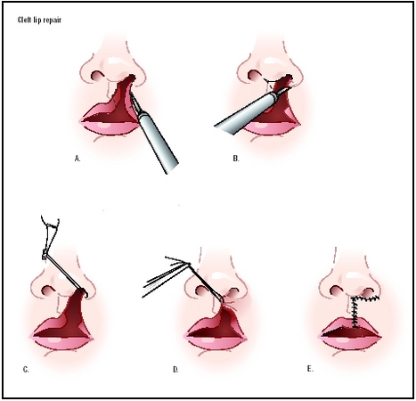 Cleft lip repair. The edges of the cleft between the lip and nose are cut (A and B). The bottom of the nostril is formed with suture (C). The upper part of the lip tissue is closed (D), and the stitches are extended down to close the opening en