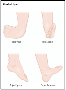The four varieties of clubfoot. Talipes varus is by far the most common type. (Illustration by GGS Information Services.)