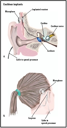 A cochlear implant has a microphone outside the ear that transmits sounds to an implanted receiver. In turn, the receiver transmits electrical impulses to the cochlea and cochlear nerve, which is stimulated in normal hearing. (Illustration by G