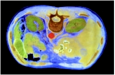 False color computed tomography scan through the abdomen, showing the liver (larger yellow organ) and spleen (smaller yellow organ). The abdominal aorta is colored red and located above the spine and between the kidneys. (Photo Researchers, Inc