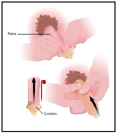 A condom is most effective when it is placed on the penis correctly without trapping air between the penis and the condom. (Illustration by Argosy, Inc.)