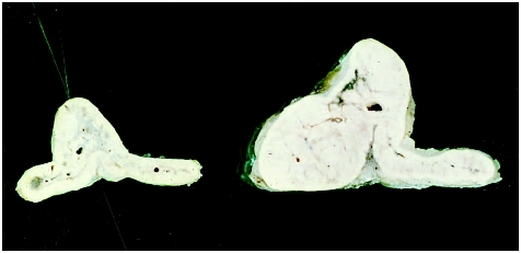 Adrenal cortical hyperplasia. The adrenal on the left is normal, the right shows hyperplasia. (Photo Researchers, Inc.)