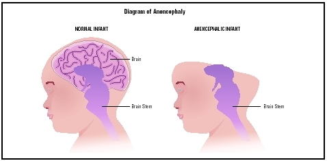 Comparison of the brain of a normal infant with the brain of an infant with anencephaly. (Illustration by Argosy, Inc.)