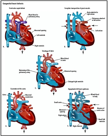 The most common types of congenital heart defects are ventricular septal defect (A), complete transposition of the great vessels (B), tetralogy of Fallot (C), coarctation of the aorta (D), and hypoplastic left heart syndrome (E). (Illustration 