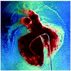 An angiogram of a ventricular septal defect, a congenital heart disease that causes a hole in the center wall of the heart, which normally completely divides the two ventricles, or lower chambers. (Photograph by Simon Fraser/Science Photo Libra