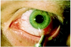 An antibotic eye ointment is applied to relieve bacterial conjunctivitis. ( T. Bannor/Custom Stock Medical Photo, Inc.)