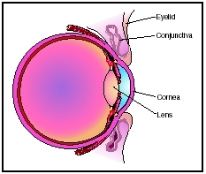 Conjunctivitis is the inflammation of the conjunctiva, a thin, delicate membrane that covers the eyeball and lines the eyelid. It may be caused by a viral infection, such as a cold or acute respiratory infection, or by such diseases as measles,