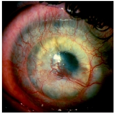 A close-up view of an abrasion on patients cornea. (Photograph by Dennis R. Cain. Custom Medical Stock Photo, Inc.)