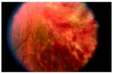 An infected retina caused by a cytomegalovirus. (Photograph by Paula Ihnat. Custom Medical Stock Photo, Inc.)