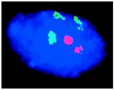 Micrograph showing trisomy 18, three copies of chromosome 18 (green) in cells nucleus (blue) versus the normal two. The two fuschia spots are the sex chromosomes, XX, a female. ( Department of Clinical Cytogenetics/Addenbrookes Hospital/Science