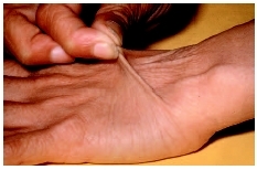 Elasticity of the skin is one characteristic of Ehlers-Danlos syndrome. (Photo Researchers, Inc.)