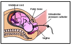 Electronic fetal monitoring (EFM) is performed late in pregnancy or continuously during labor to ensure normal delivery of a healthy baby. EFM can be utilized either externally or internally in the womb. This illustration shows the internal pro