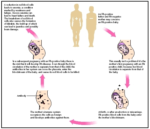 Flow chart demonstrating how Rh disease is carried to fetus through mother. (Illustration by Hans  Cassidy.)