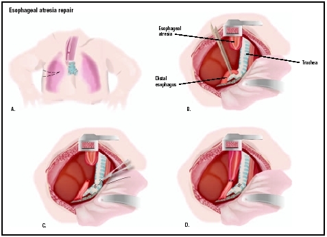 To repair esophageal atresia, an opening is cut into the chest (A). The two parts of the existing esophagus are identified (B). The lower esophagus is detached from the trachea (C) and connected to the upper part of the esophagus (D). (Illustra