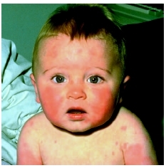 Infant with a rash caused by fifth disease, or erythema infectiosum. (Custom Medical Stock Photo, Inc.)