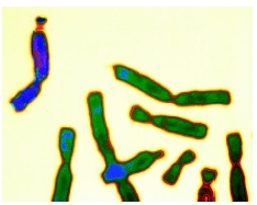 Fragile X chromosome, shaded in purple at upper left corner, is shown among other chromosomes. ( Siebert/Custom Medical Stock Photo, Inc)