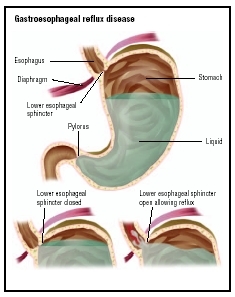 Normally, the lower esophageal sphincter keeps the stomach contents contained with the stomach (top). However, with gastroesophageal reflux disease, the sphincter opens, allowing the acidic contents to flow up the esophagus. (Illustration by GG