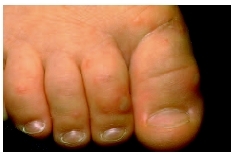 Blisters shown on the foot a child with hand-foot-mouth disease. (Custom Medical Stock Photo, Inc.)