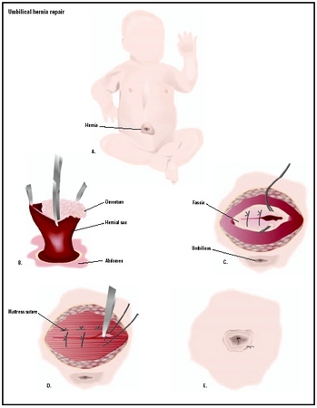 Baby with an umbilical hernia (A). To repair, the hernia is cut open (B), and the contents replaced in the abdomen. Connecting tissues, or fascia, are sutured closed (C), and the skin is repaired (D). (Illustration by GGS Information Services.)