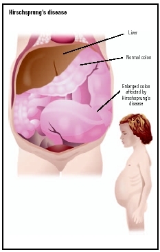 In Hirschsprungs disease, the flow of contents through the large intestine is halted, causing some areas to enlarge greatly. This causes many symptoms in the patient, including a distended abdomen. (Illustration by GGS Information Services.)
