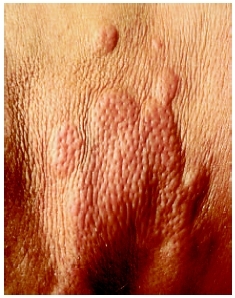 Hives on the back of a young womans legs. The accompanying inflammation develops as an allergic reaction which ranges in size from small spots to patches measuring several inches across. ( 1994 Caliendo/Custom Medical Stock Photo, Inc.)