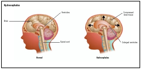 A normal brain (left) and one showing the enlarged ventricles of hydrocephalus. The additional fluid in the ventricles causes increased pressure on the brain. (Illustration by GGS Information Services.)