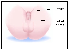 Hypospadias, a condition in which the urethral opening is not at the tip of the penis, but rather along the penile shaft. (Illustration by Argosy, Inc.)