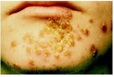 Impetigo is a contagious bacterial skin infection that has affected the area around this patients nose and mouth. (NMSB/Custom Stock Medical Photo, Inc.)
