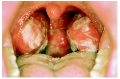 Sore throat and swollen tonsils caused by infectious mononucleosis, frequently called mono or the kissing disease. (Photograph by Dr. P. Marazzi. Science Photo Library/Photo Researchers, Inc.)