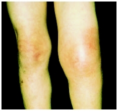 Swelling in the patients left knee from an allergic reaction to a wasp sting. ( Dr. P. Marazzi/Photo Researchers, Inc.)